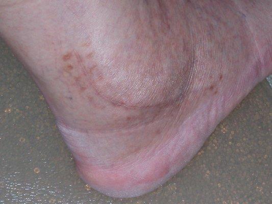 Ankle surgery scar over 2 years later.