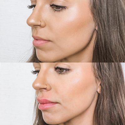 Before and after Lip Augmentation