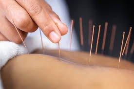 Acupuncture treatment