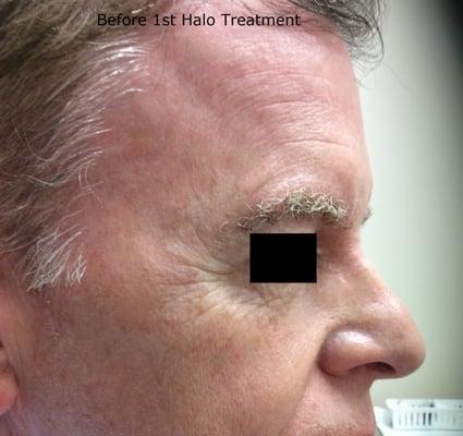 Before Halo Skin Resurfacing Laser treatment