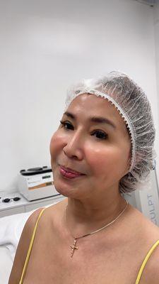 After Microneedling PRP