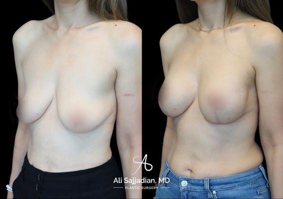 Before and After | Breast Augmentation and Lift