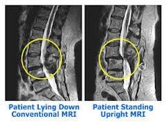 The Stand-Up MRI has the unique ability to detect problems that are underestimated or completely missed by other kinds of MRIs.