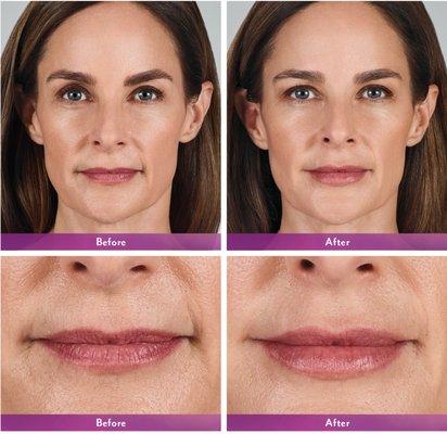 Lip Augmentation Volbella