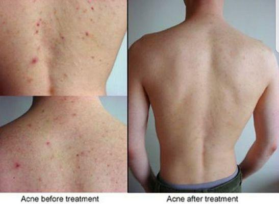 I help treat BACK ACNE.