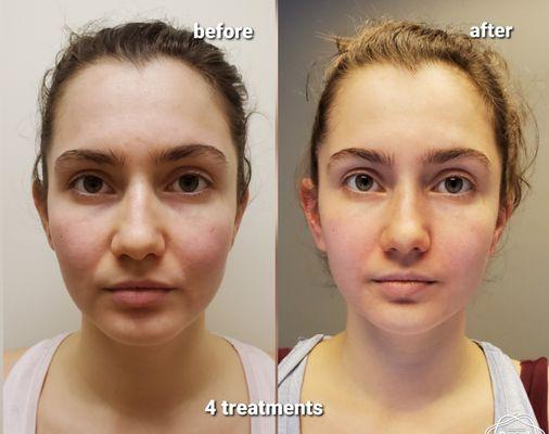 Face is looking more defined and lifted. Smile lines are smoothed out. Puffiness is reduced.