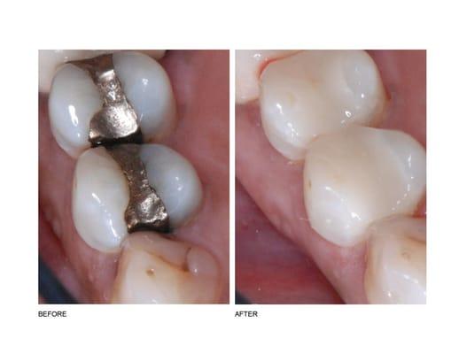 Cerec Inlays & Onlays