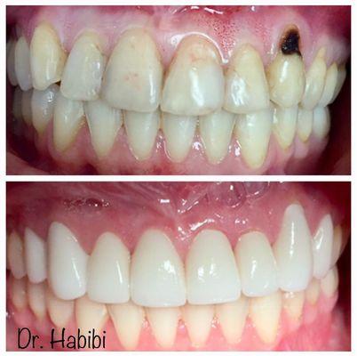 Teeth with a lot of decay and old fills can be fixed with crowns to give you a beautiful smile!