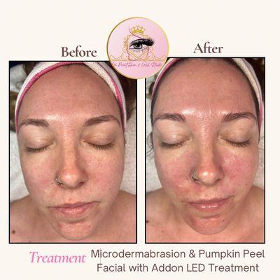 Microdermabrasion & Pumpkin Peel facial