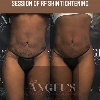 Before and after one session of RF Skin tightening