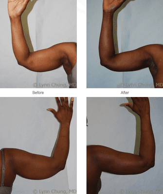 Upper Arm Liposuction