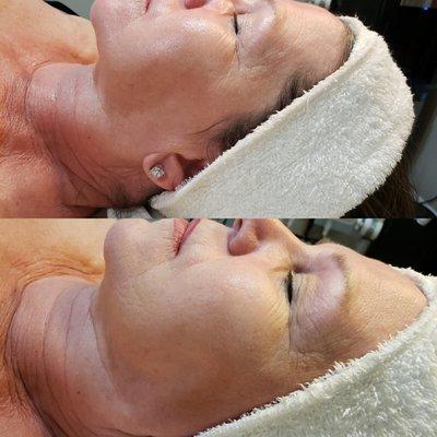 These are the before and after photos after 1 microdermabrasion facial