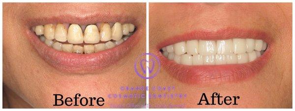 Full mouth reconstruction before and after pictures