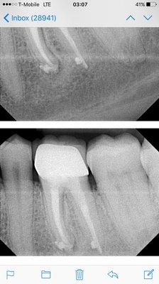 See what I mean :) no more infection :) say hello to a healthy tooth :D number 19 :) now I need a crown cause dr Robinson ruined mine