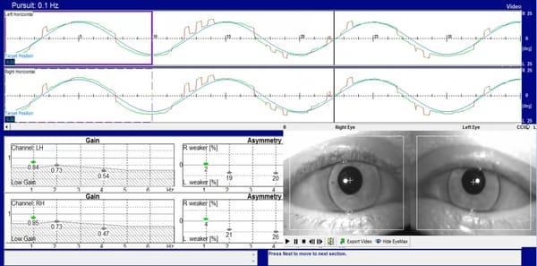 Videonystagmography (VNG) is just one of our cutting edge diagnostic tools. You can find a short PowerPoint presentation on o...