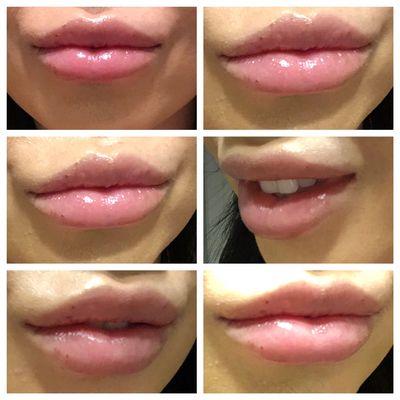 Lip augmentation.  Left panel is right after injection, and the right panel is about one week after injection.