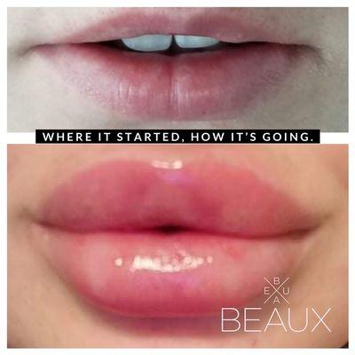 Lip fillers Austin