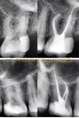 Dr. Nguyen is amazing with root canal.