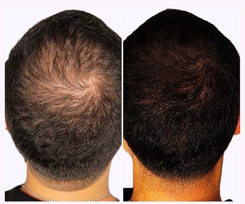 Male Scalp Micro pigmentation