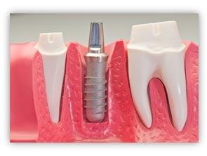 Dental Implants