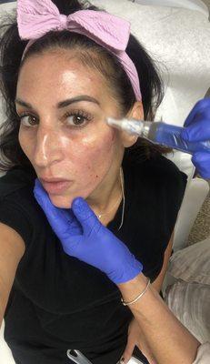 Microneedling session with stem cells