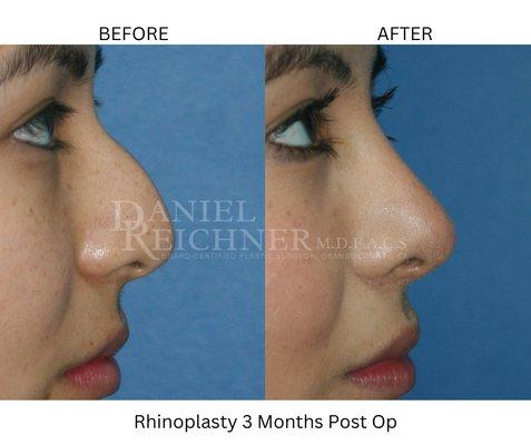 Rhinoplasty Before & After 3 Months Post Op