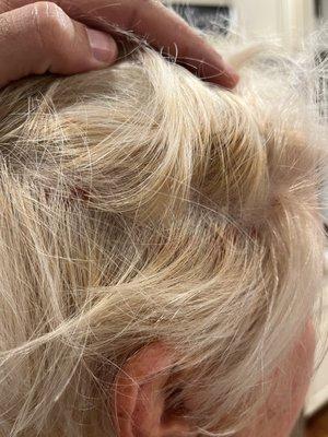 Scalp blistering due to bleach