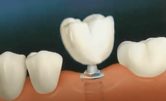 Parlin dental implants