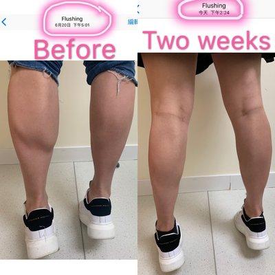 Leg slimming