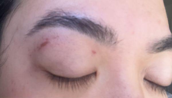 eyebrow waxing, some skin got peeled off from the wax under my eye.