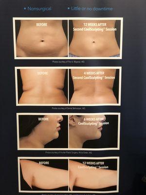 Coolsculpting, the #1 nonsurgical fat reduction treatment.