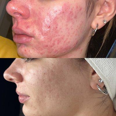 Acne Bootcamp with Madelyn