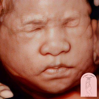 5D/HD ultrasound + our newest "RealFace" feature