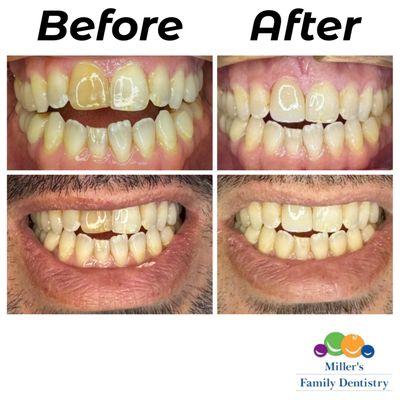 Single tooth darker than the rest? We got you COVERED with a full coverage crown to restore your smile!