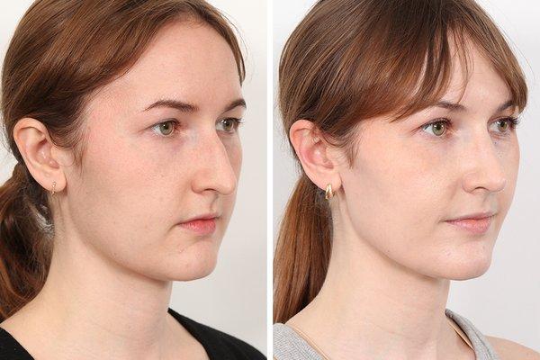 8 months after open rhinoplasty by Dr. Ben Paul