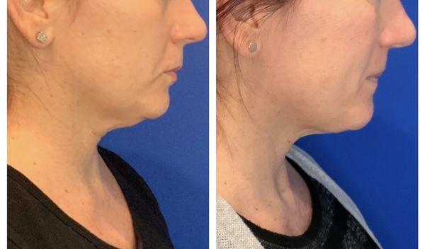 CoolSculpting to submental (chin) area. Left = Before treatment; Right = approx 2 months After ONE treatment.