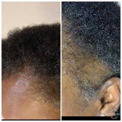 Before and after scalp pigmentation