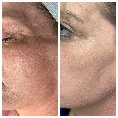 Aquagold before and after by AH Laser Aesthetics