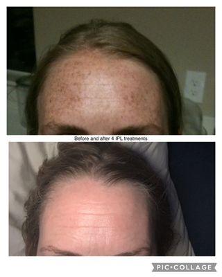 IPL treatments for freckle removal after 4 treatments.