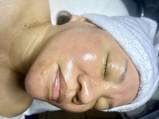 3rd facial treatment