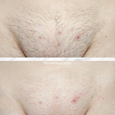 Before and after of a Brazilian Wax