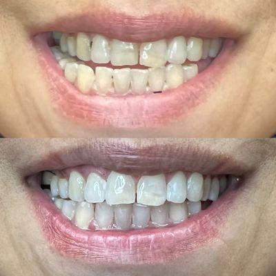 Teeth whitening client