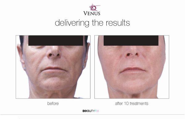 Radiofrequency skin tightening