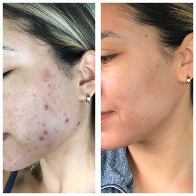 Clear Skin is possible! Book your in person or virtual acne consult and treatment!