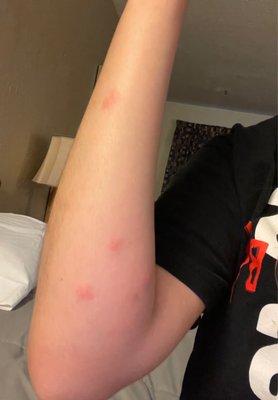 Bed bug bites