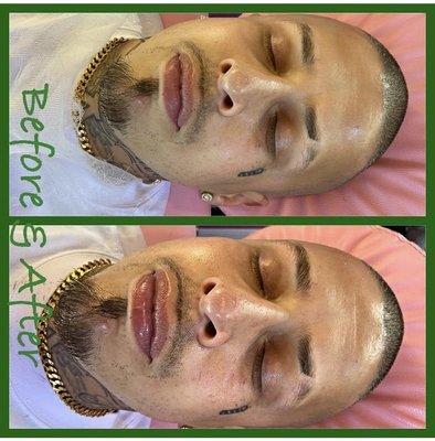 Basic facial