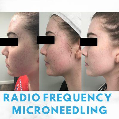 Before and after 3 radio frequency microneedling treatments for acne scarring.