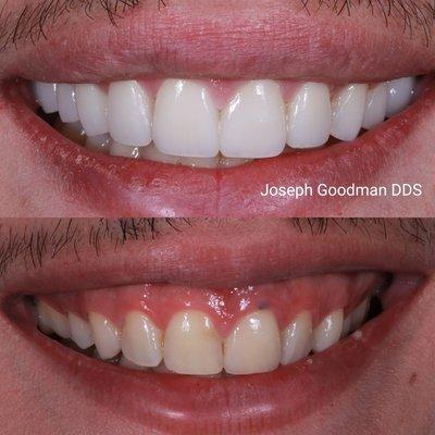 Porcelain veneers and gummy Smile corrections by Joseph Goodman DDS