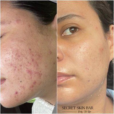 Before and After Acne Bootcamp 4 months