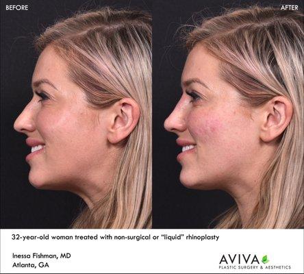 Nonsurgical or liquid rhinoplasty allows for immediate reshaping of the nose without surgery or recovery.